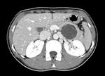 Robot-assisted spleen preserving distal pancreatectomy: case report