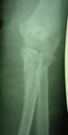 A rare cause of elbow stiffness after internal fixation of proximal ulna fracture: a case report of heterotopic ossification