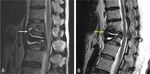 Cement bridging phenomenon in percutaneous vertebroplasty for adjacent vertebral compression fracture