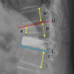 Cement bridging phenomenon in percutaneous vertebroplasty for adjacent vertebral compression fracture