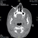 Preseptal cellulitis and infraorbital abscess as a complication of a routine COVID-19 swab