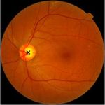 New Hypertensive Retinopathy Grading Based on the Ratio of Artery Venous Diameter from Retinal Image