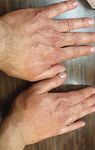 COVID-19 and skin: Analysis of the available data - Our Dermatology Online journal