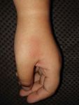 COVID-19 and skin: Analysis of the available data - Our Dermatology Online journal