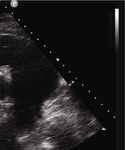 Case Report Acute Myocardial Infarction due to External Compression of the Left Main Coronary Artery by a Large Pulmonary Artery Aneurysm