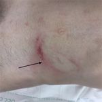 Horse Kick to the Abdomen Causing a Triad of Injury: A Case Report - Cureus
