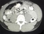 Horse Kick to the Abdomen Causing a Triad of Injury: A Case Report - Cureus