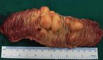 Multiple submucosal lipomas of small intestine: a case report - International ...