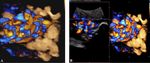 Monochorionic-Diamniotic Twin Pregnancy Complicated by Spontaneous Septostomy and Cord Entanglement: A Systematic Review, Evaluation of ...