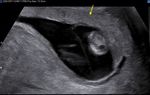 Monochorionic-Diamniotic Twin Pregnancy Complicated by Spontaneous Septostomy and Cord Entanglement: A Systematic Review, Evaluation of ...