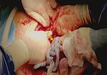 Monochorionic-Diamniotic Twin Pregnancy Complicated by Spontaneous Septostomy and Cord Entanglement: A Systematic Review, Evaluation of ...