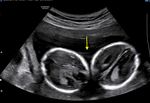 Monochorionic-Diamniotic Twin Pregnancy Complicated by Spontaneous Septostomy and Cord Entanglement: A Systematic Review, Evaluation of ...