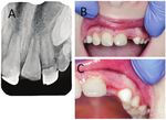 Vital root submergence of immature permanent incisors after complicated crown-root fracture followed by orthodontic space maintenance: A ...