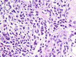 Primary Gastric Non-Hodgkin Lymphoma as Second AIDS-Defining Malignancy in a Patient under - HAART