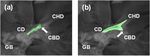Indocyanine-green-loaded microballoons for biliary imaging in cholecystectomy