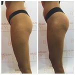 Begin your journey with Brazilian Booty Lift - Our brand is committed to dramatically increasing your clinics revenue with our revolutionary body ...