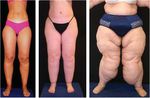 Prevention of Progression of Lipedema With Liposuction Using Tumescent Local Anesthesia; Results of an International Consensus Conference