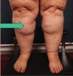 Prevention of Progression of Lipedema With Liposuction Using Tumescent Local Anesthesia; Results of an International Consensus Conference