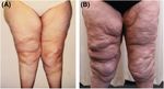 Prevention of Progression of Lipedema With Liposuction Using Tumescent Local Anesthesia; Results of an International Consensus Conference