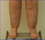 Prevention of Progression of Lipedema With Liposuction Using Tumescent Local Anesthesia; Results of an International Consensus Conference