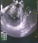 Radiofrequency ablation, A new paradigm for the treatment of adenomyosis: Case series - Sohag Medical Journal