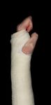 Fractured wrist - after surgery - Information for patients Introduction - Imperial College Healthcare ...