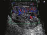 Contents of the inguinal canal: identification by different imaging methods - SciELO
