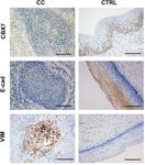 Decreased chromobox homologue 7 expression is associated with epithelial-mesenchymal transition and poor prognosis in cervical cancer
