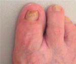 The Success of Topical Treatment of Onychomycosis Seems to Be Influenced by Fungal Features