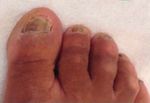 The Success of Topical Treatment of Onychomycosis Seems to Be Influenced by Fungal Features