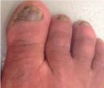 The Success of Topical Treatment of Onychomycosis Seems to Be Influenced by Fungal Features