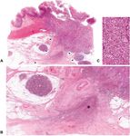 Histopathological atlas of desmoplastic reaction characterization in colorectal cancer - Oxford Academic Journals