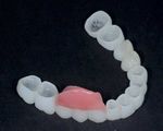 Computer aided manufacturing and design of fixed bridges restoring the lost dentition, soft tissue and the bone