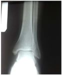 Pure Talocrural Dislocation without Associated Malleolar Fracture