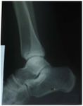 Pure Talocrural Dislocation without Associated Malleolar Fracture