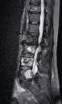 Initial Clinical Experience with an Iterative Denoising Algorithm Applied to Reduced-data 2D Turbo Spin Echo Acquisitions