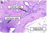The Effects of Chemotherapeutics on the Ovarian Cancer Microenvironment