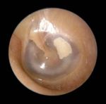 Hearing Loss Case - Click to Begin - A Self-Directed Learning Module Department of Otolaryngology - Head & Neck Surgery - Western University