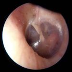 Hearing Loss Case - Click to Begin - A Self-Directed Learning Module Department of Otolaryngology - Head & Neck Surgery - Western University