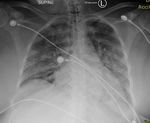 Clinical Presentation of a COVID-19 Delta Variant Patient: Case Report and Literature Review