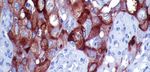 IHC PANEL MARKERS Ovarian Cancer - BioGenex