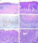HPV-negative Squamous Cell Carcinomas of the Cervix With Special Focus on Intraepithelial Precursor Lesions