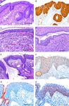 HPV-negative Squamous Cell Carcinomas of the Cervix With Special Focus on Intraepithelial Precursor Lesions