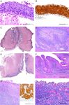 HPV-negative Squamous Cell Carcinomas of the Cervix With Special Focus on Intraepithelial Precursor Lesions