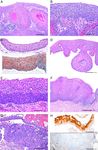 HPV-negative Squamous Cell Carcinomas of the Cervix With Special Focus on Intraepithelial Precursor Lesions