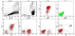 De novo chronic lymphocytic leukemia/prolymphocytic leukemia or B-cell prolymphocytic leukemia? The importance of integrating ...