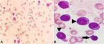 De novo chronic lymphocytic leukemia/prolymphocytic leukemia or B-cell prolymphocytic leukemia? The importance of integrating ...