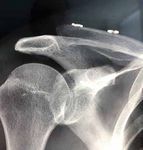 Acromioclavicular Ligamentoplasty - OPERATING TECHNIQUE - VIMS
