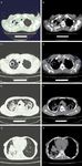 Original Article Feasibility study of imaging diagnosis of diabetes mellitus patients with pulmonary tuberculosis