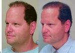 Hair Restoration Complications: An Approach to the Unnatural-Appearing Hair Transplant